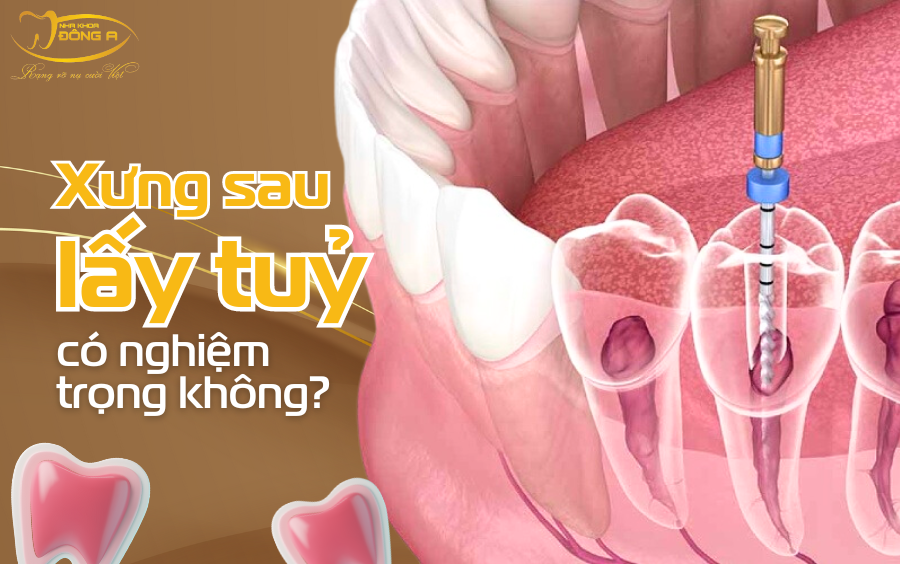 lay-tuy-rang