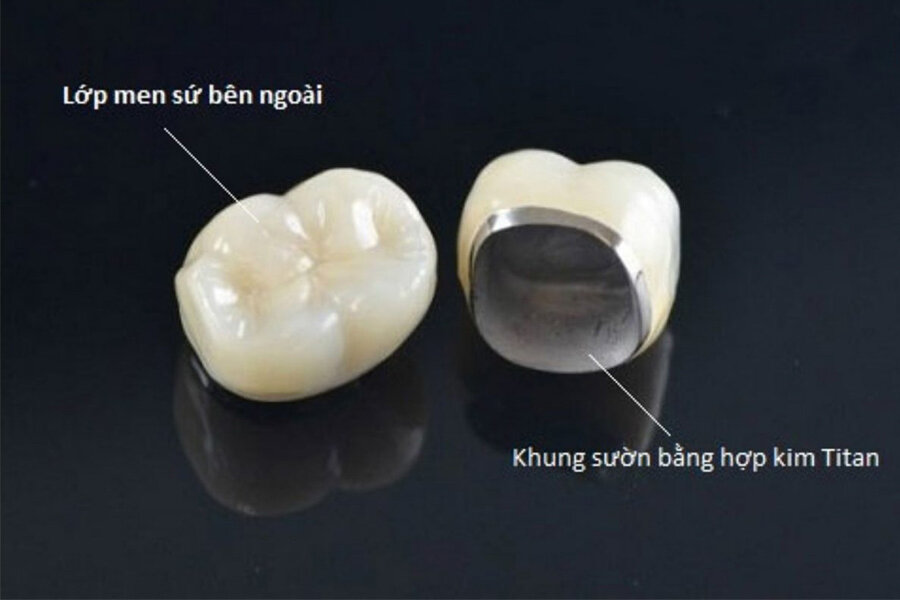 Răng Sứ Kim Loại
