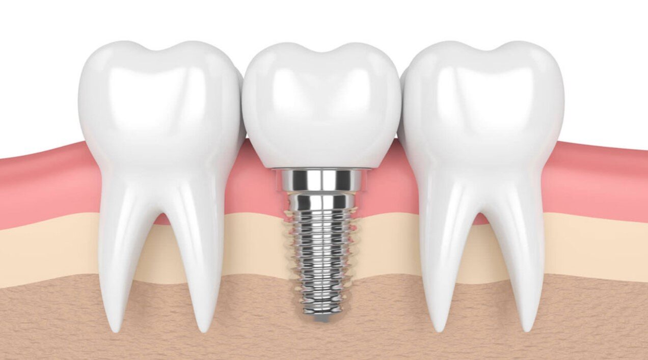 Trong Rang Implant 11