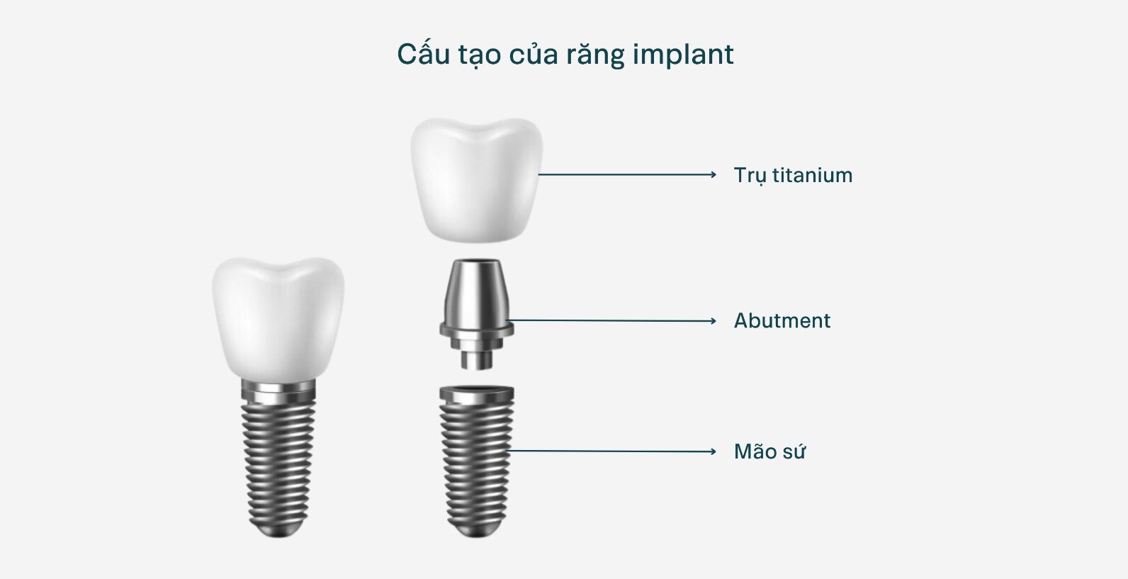 Trong Rang Implant 2
