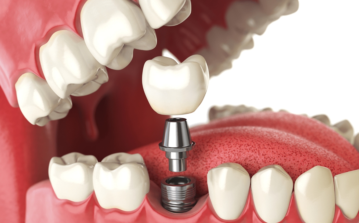 Trồng răng Implant có nguy hiểm không