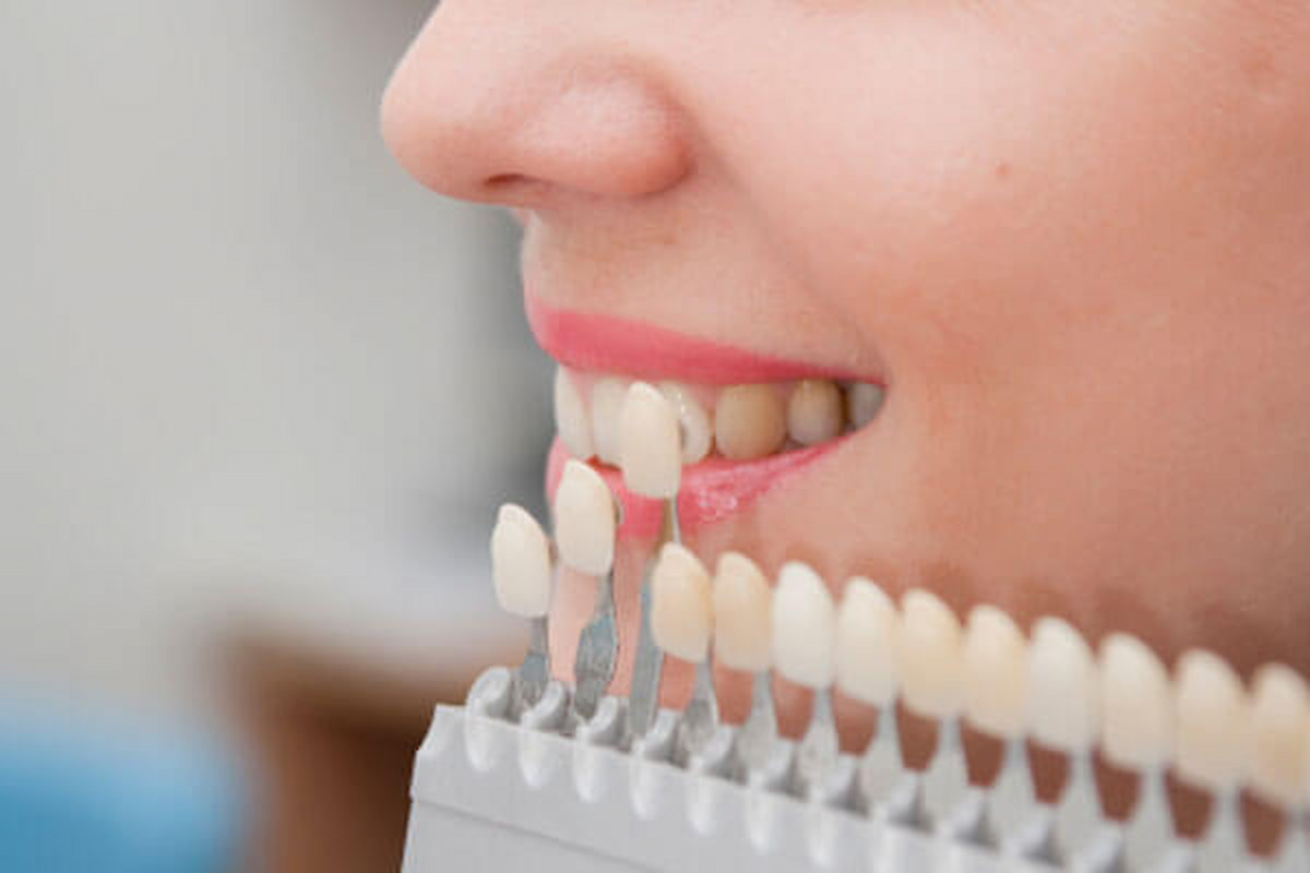 Bảng màu răng sứ Zirconia
