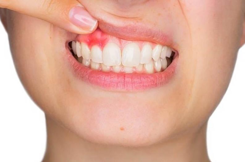 Răng gặp vấn đề về viêm nha chu