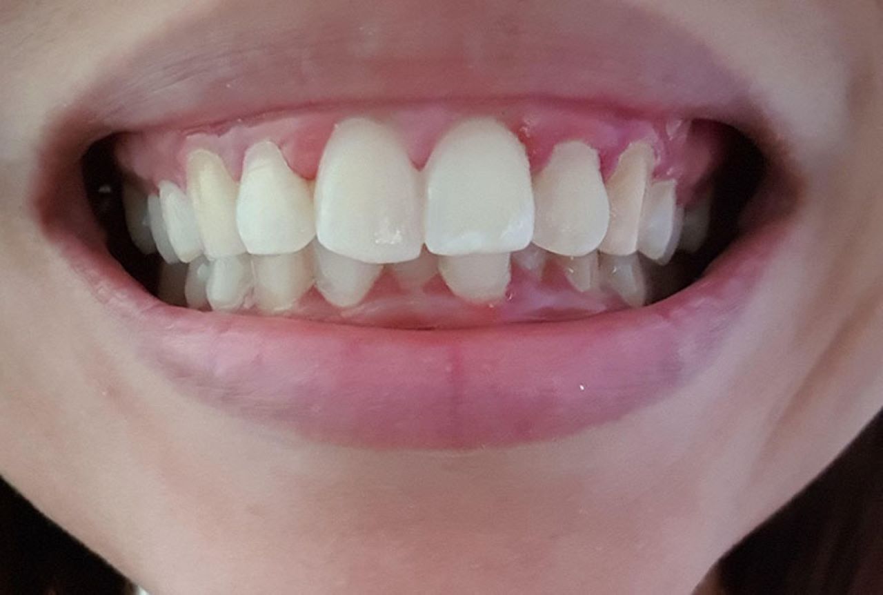Răng bị tổng thương do bệnh lý răng miệng