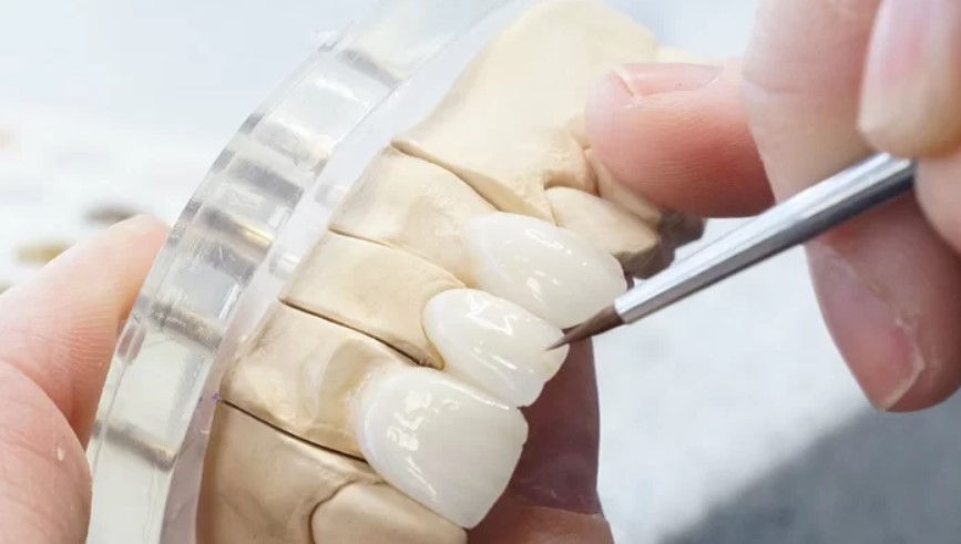 Làm thế nào để phân biệt răng sứ Đức thật giả?