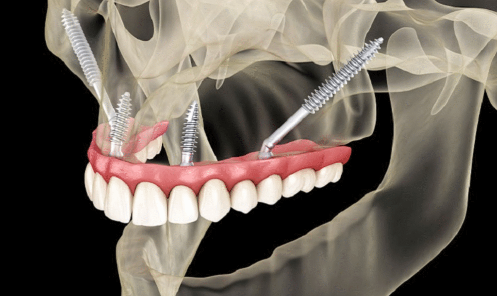 Cấy ghép Implant xương gò má