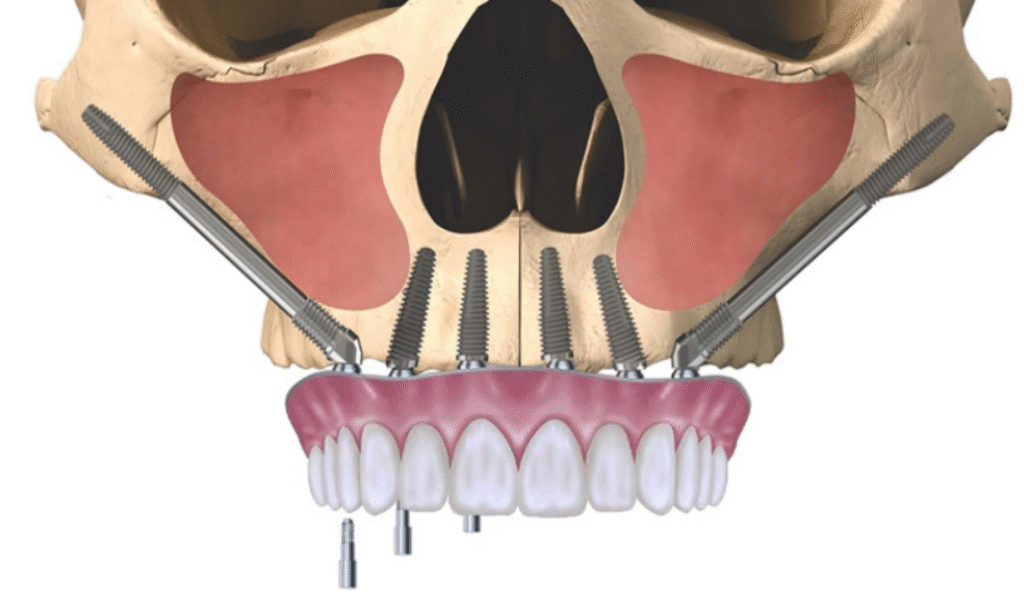 Ưu điểm của phương pháp cấy ghép Implant xương gò má