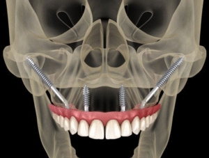 Implant xương gò má