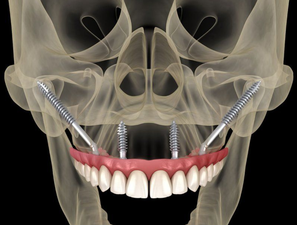 Implant xương gò má